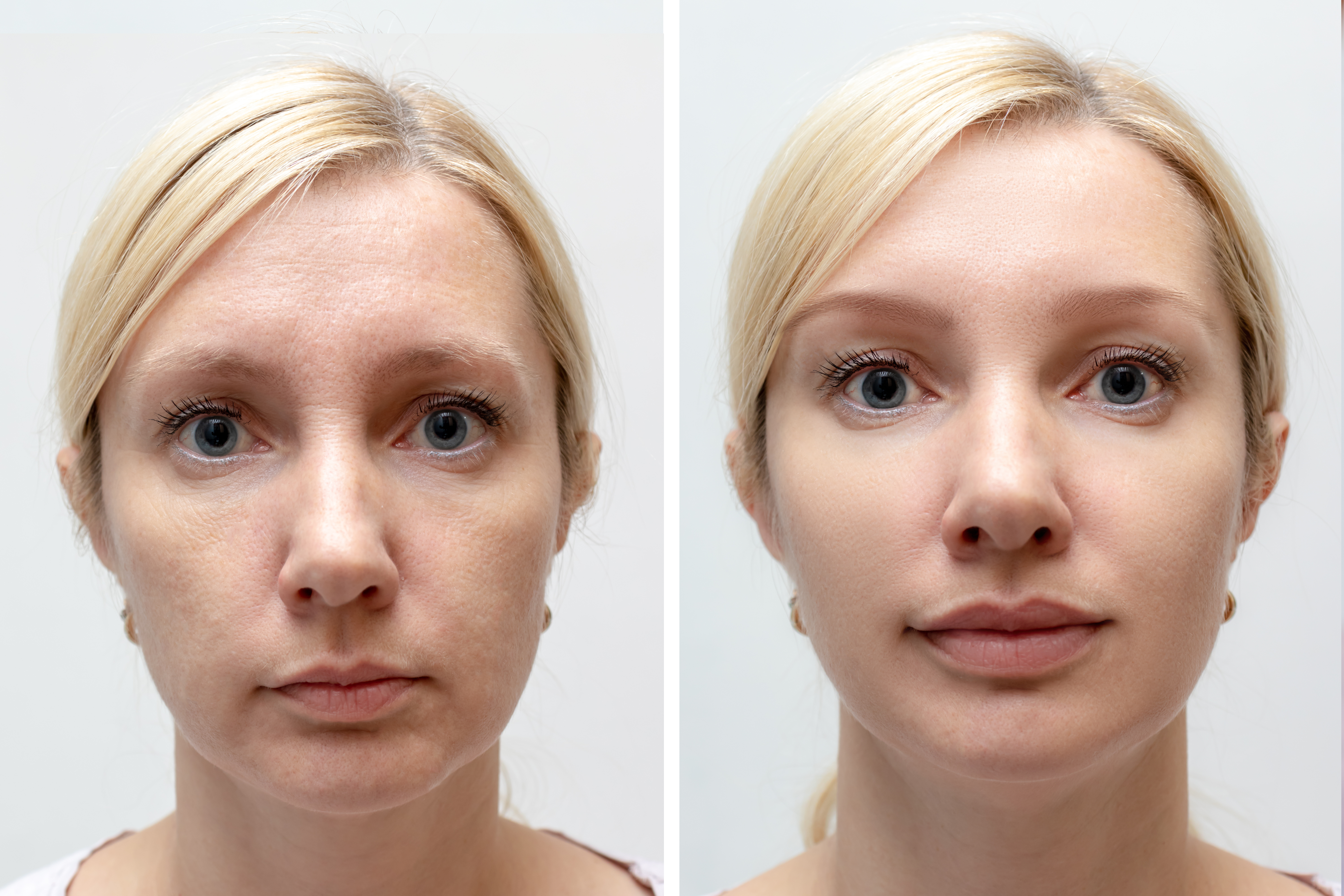 voordelen chirurgische liplift voordelen chirurgische liplift